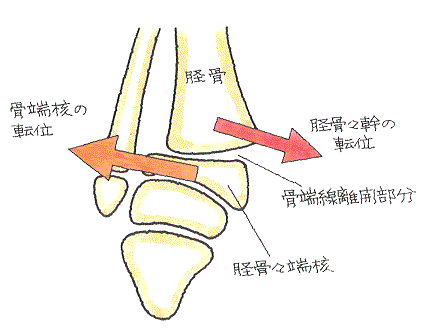 骨端線損傷‐脛骨の骨端線を横断するように骨端線が離開したもの