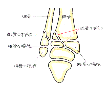 骨端線損傷-足関節捻挫に伴う、脛骨骨端の斜骨折、腓骨の斜骨折