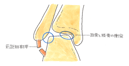 距骨と脛骨の衝突