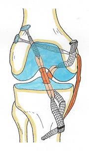 膝関節-複合靭帯損傷